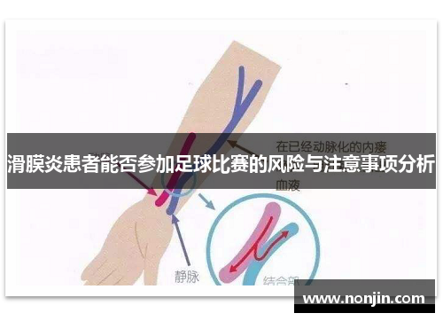 滑膜炎患者能否参加足球比赛的风险与注意事项分析